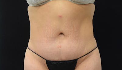 Massive Weight Loss Before & After Gallery - Patient 102457114 - Image 2