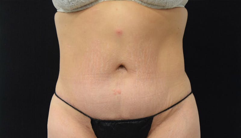 Massive Weight Loss Before & After Gallery - Patient 102457114 - Image 2