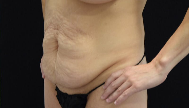 Massive Weight Loss Gallery - Patient 102457114 - Image 3