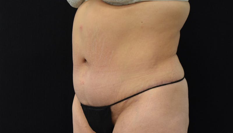 Massive Weight Loss Before & After Gallery - Patient 102457114 - Image 4