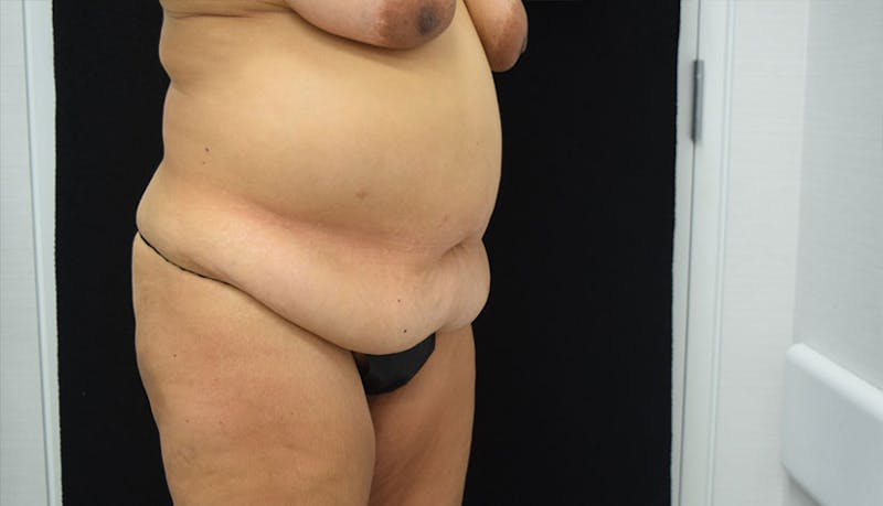 Abdominoplasty Before & After Gallery - Patient 102457120 - Image 7