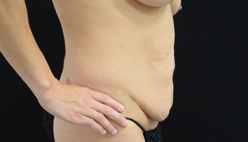 Massive Weight Loss Gallery - Patient 102457114 - Image 5