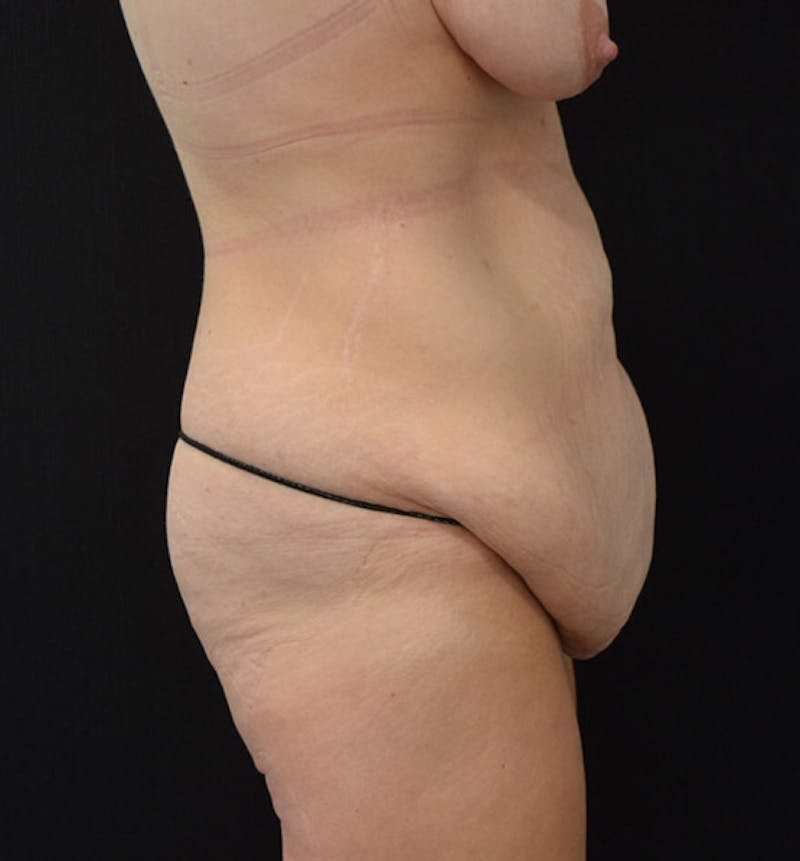 Lower Body Lift Before & After Gallery - Patient 102457116 - Image 5