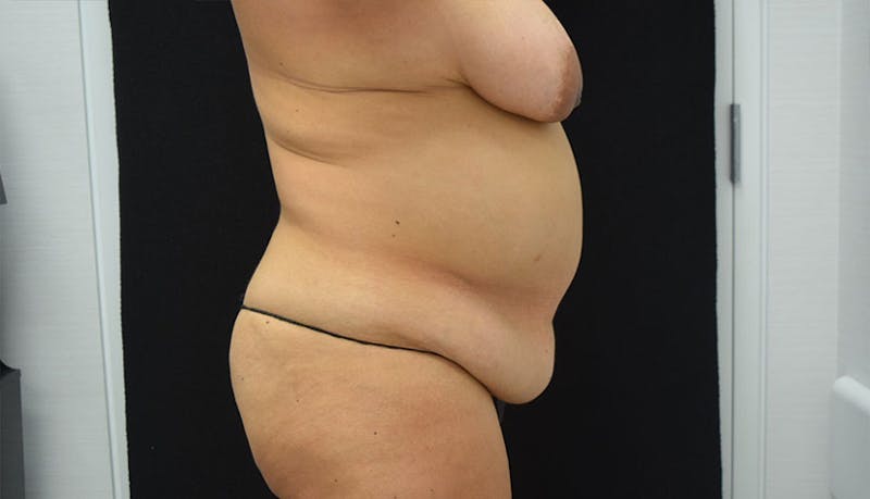 Abdominoplasty Before & After Gallery - Patient 102457120 - Image 9