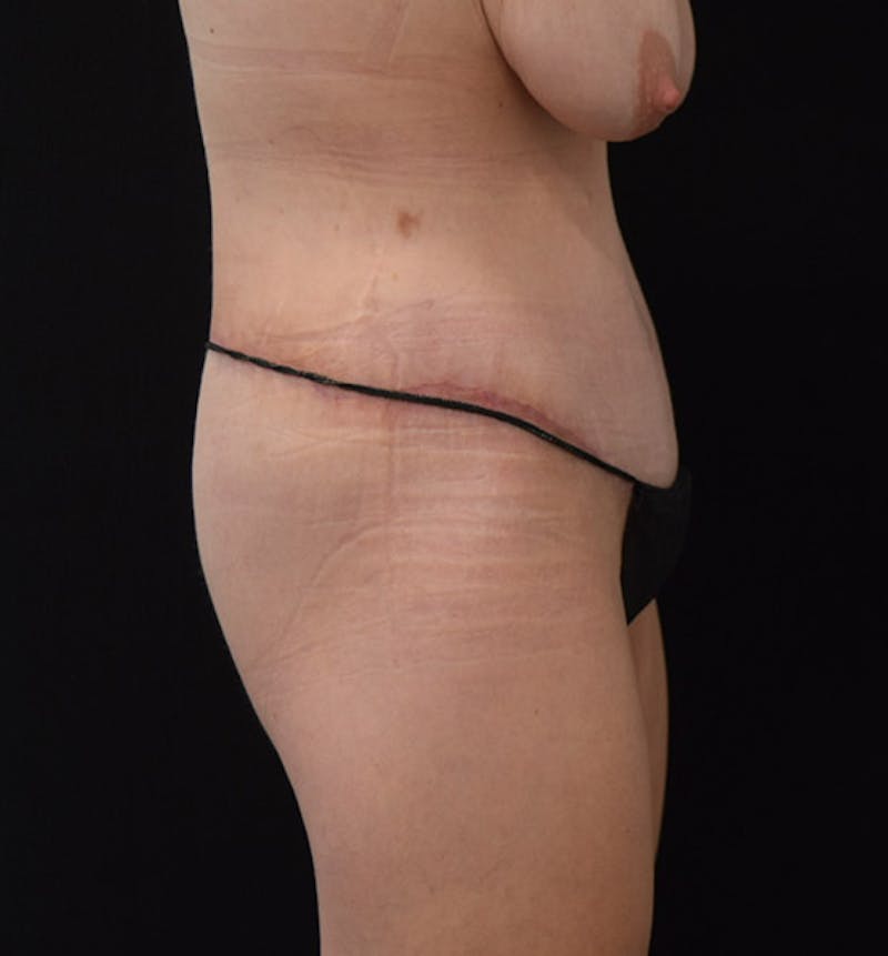 Lower Body Lift Before & After Gallery - Patient 102457116 - Image 6