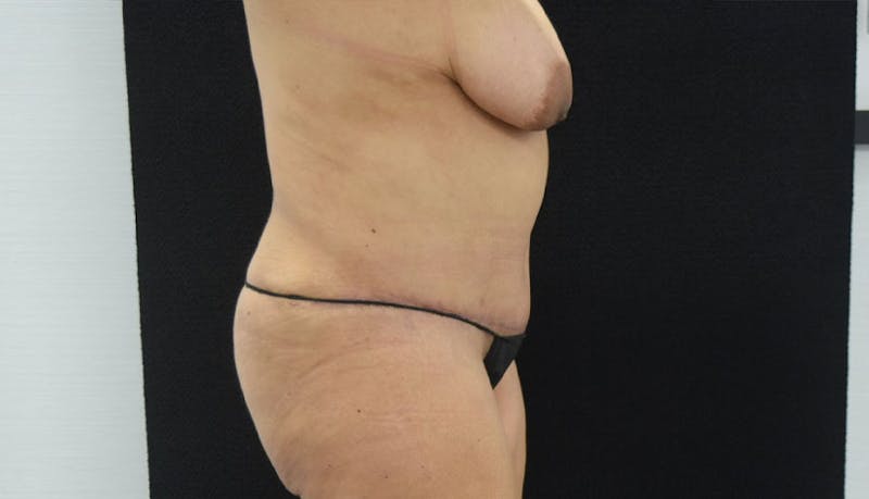 Abdominoplasty Before & After Gallery - Patient 102457120 - Image 10