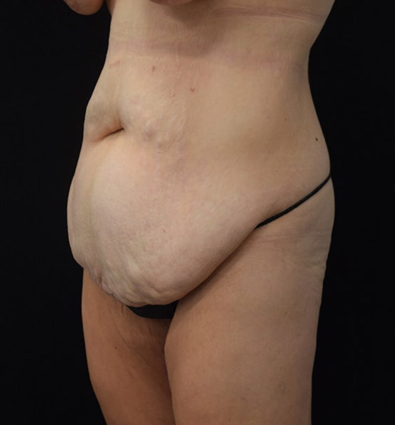 Lower Body Lift Before & After Gallery - Patient 102457116 - Image 7