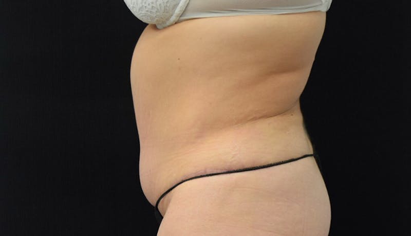 Massive Weight Loss Before & After Gallery - Patient 102457114 - Image 8