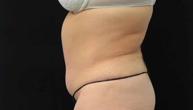 Massive Weight Loss Before & After Gallery - Patient 102457114 - Image 8