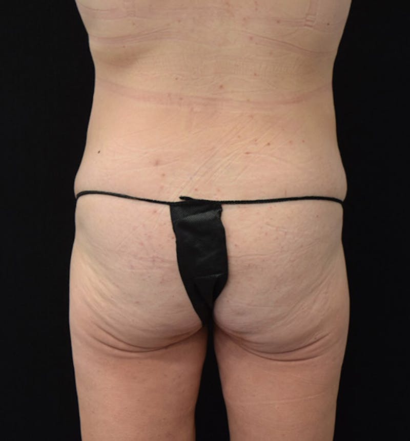 Lower Body Lift Before & After Gallery - Patient 102457116 - Image 11