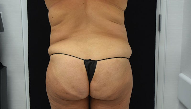 Abdominoplasty Before & After Gallery - Patient 102457120 - Image 11