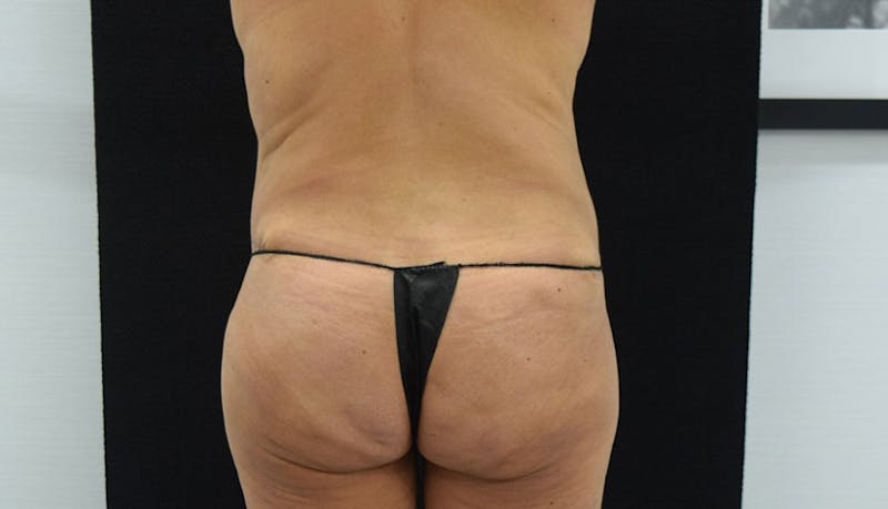 Abdominoplasty Before & After Gallery - Patient 102457120 - Image 12