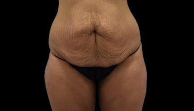 Massive Weight Loss Before & After Gallery - Patient 102457150 - Image 1