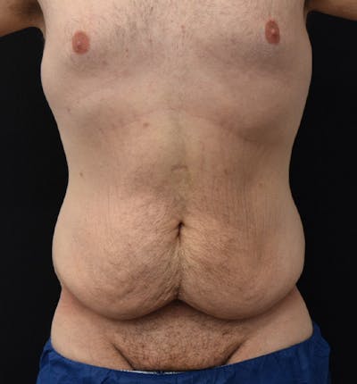 Lower Body Lift Before & After Gallery - Patient 148037527 - Image 1