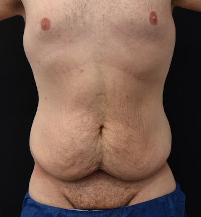 Male Lower Body Lift Before & After Gallery - Patient 148037527 - Image 1