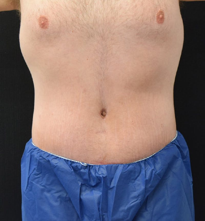 Lower Body Lift Before & After Gallery - Patient 102457141 - Image 2