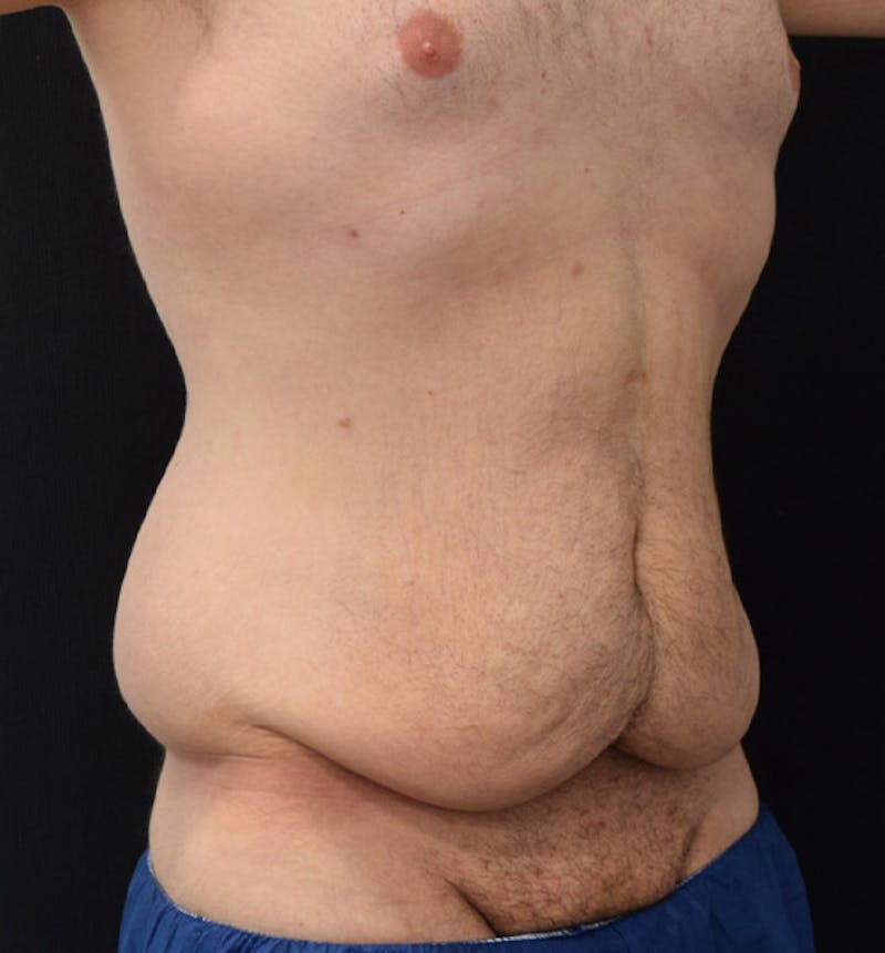 Lower Body Lift Before & After Gallery - Patient 102457141 - Image 3