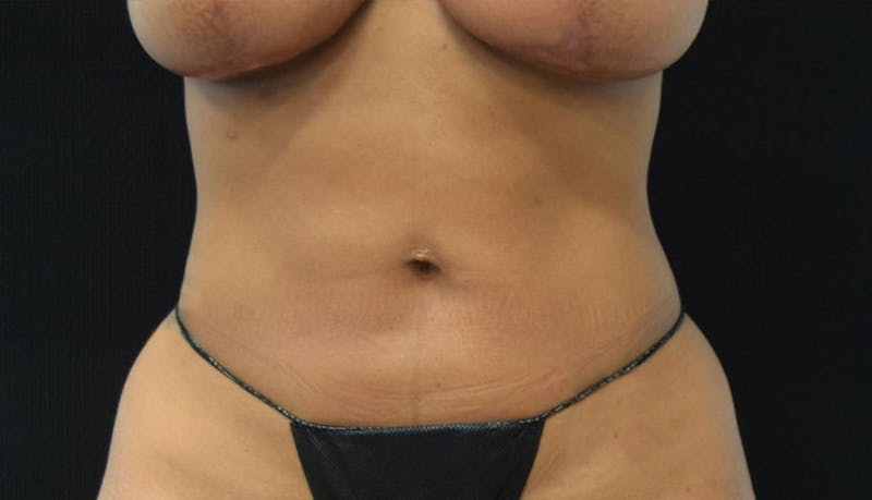 Abdominoplasty Before & After Gallery - Patient 102457142 - Image 2