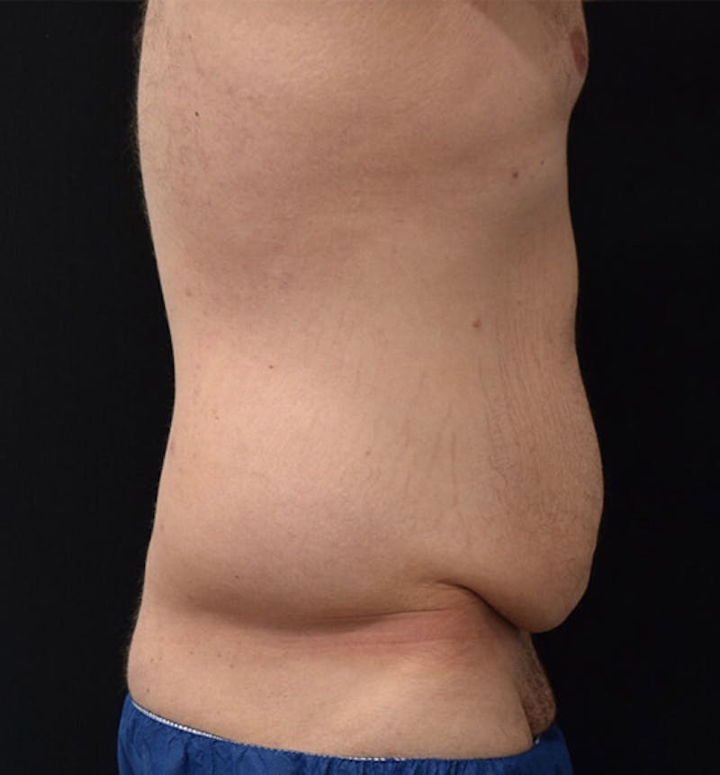 Lower Body Lift Before & After Gallery - Patient 148037527 - Image 5