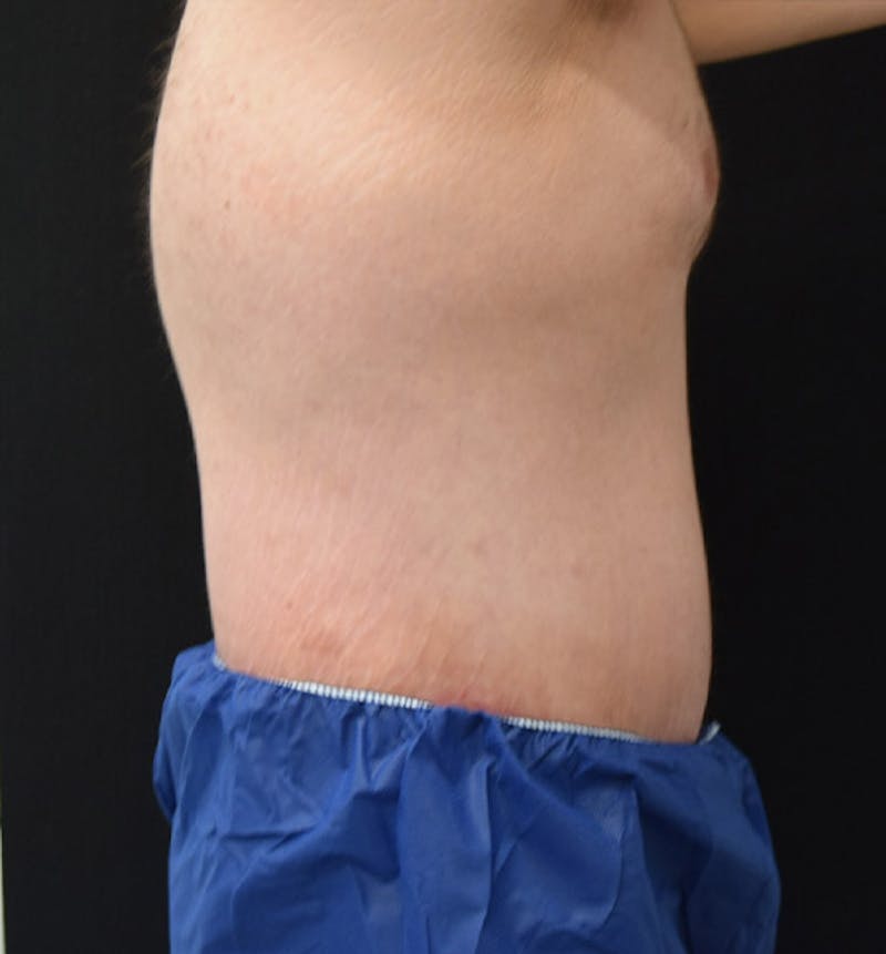 Lower Body Lift Before & After Gallery - Patient 148037527 - Image 6