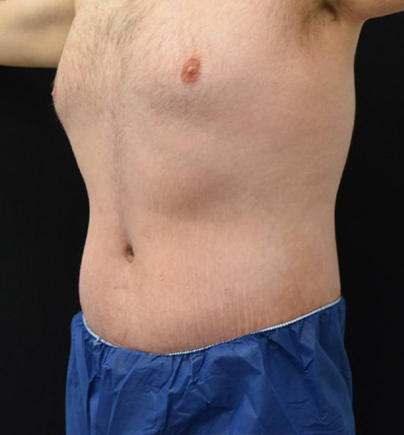 Lower Body Lift Before & After Gallery - Patient 102457141 - Image 8