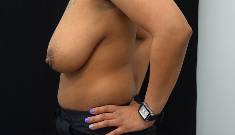 Abdominoplasty Before & After Gallery - Patient 102457142 - Image 5