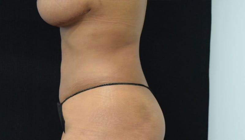 Abdominoplasty Before & After Gallery - Patient 102457142 - Image 6