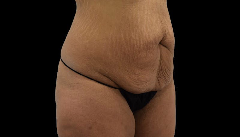 Massive Weight Loss Before & After Gallery - Patient 102457150 - Image 7