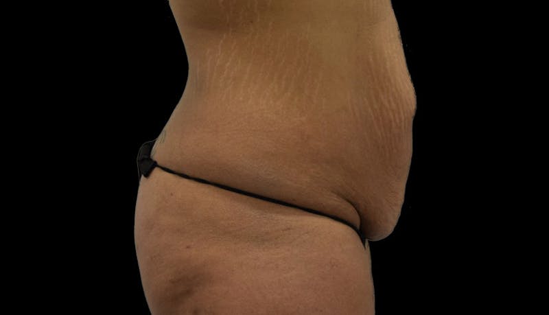 Massive Weight Loss Before & After Gallery - Patient 102457150 - Image 9