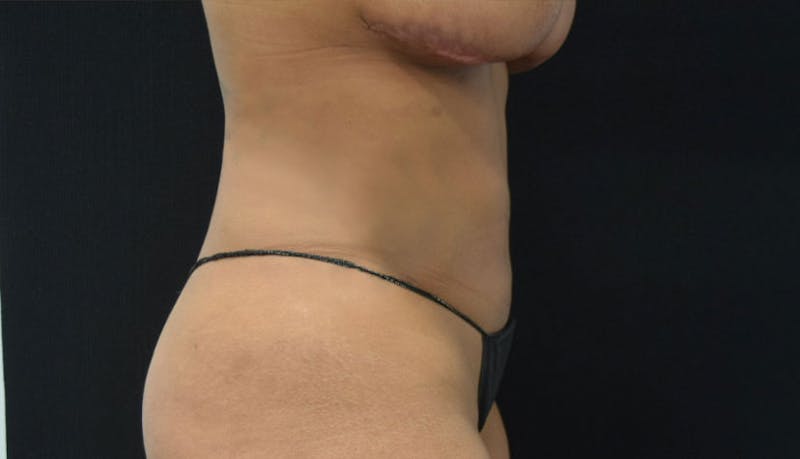 Abdominoplasty Before & After Gallery - Patient 102457142 - Image 10