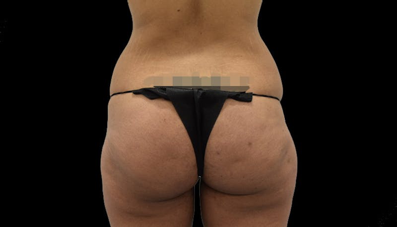 Massive Weight Loss Gallery - Patient 102457150 - Image 11
