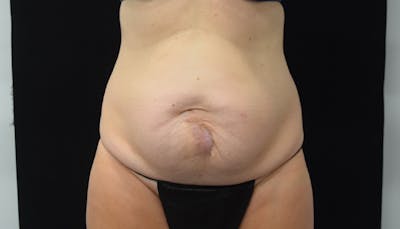 Abdominoplasty Before & After Gallery - Patient 102468564 - Image 1
