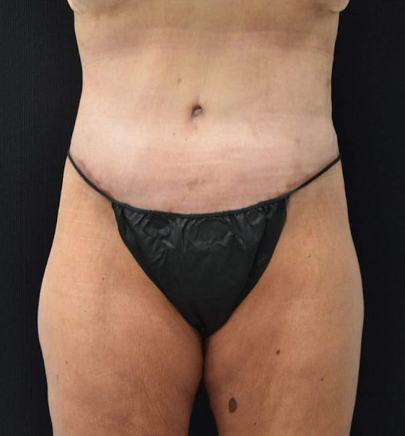 Lower Body Lift Before & After Gallery - Patient 102457163 - Image 2