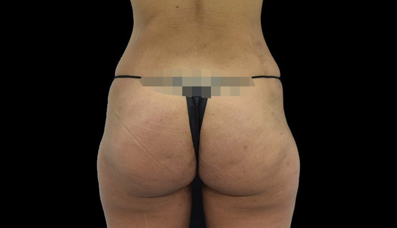 Massive Weight Loss Before & After Gallery - Patient 102457150 - Image 12