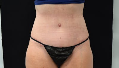 Abdominoplasty Before & After Gallery - Patient 102468564 - Image 2