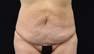 Massive Weight Loss Before & After Gallery - Patient 102563717 - Image 1