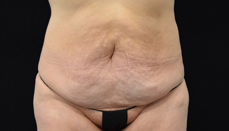 Massive Weight Loss Gallery - Patient 102563717 - Image 1