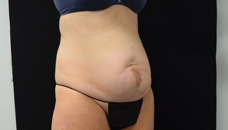 Abdominoplasty Before & After Gallery - Patient 102468564 - Image 3
