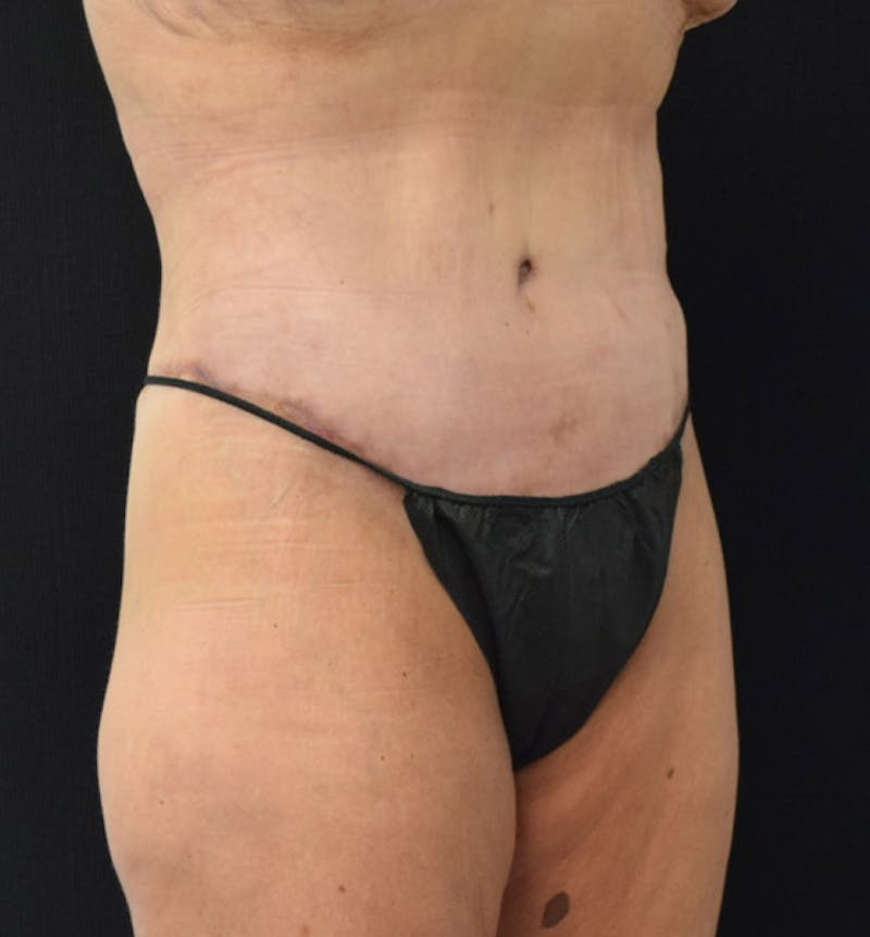 Lower Body Lift Before & After Gallery - Patient 102457163 - Image 4