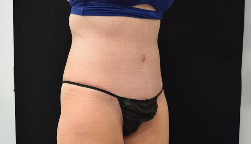 Abdominoplasty Before & After Gallery - Patient 102468564 - Image 4