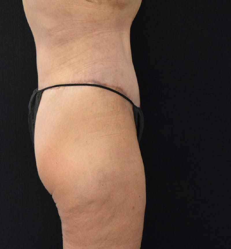 Lower Body Lift Before & After Gallery - Patient 102457163 - Image 6