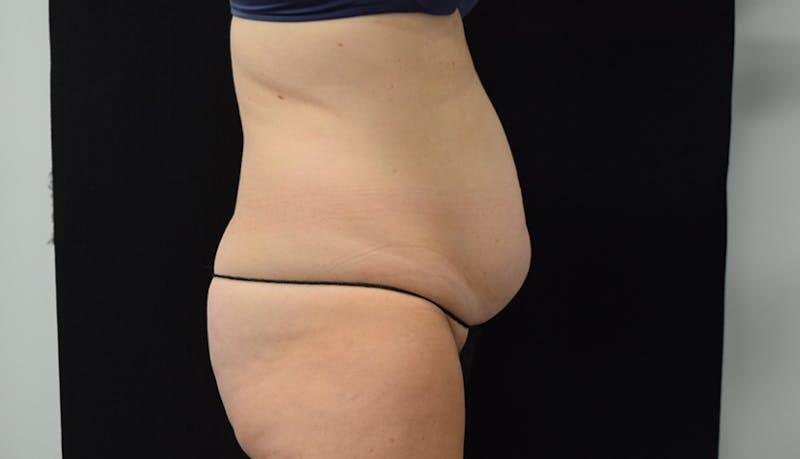 Abdominoplasty Before & After Gallery - Patient 102468564 - Image 5