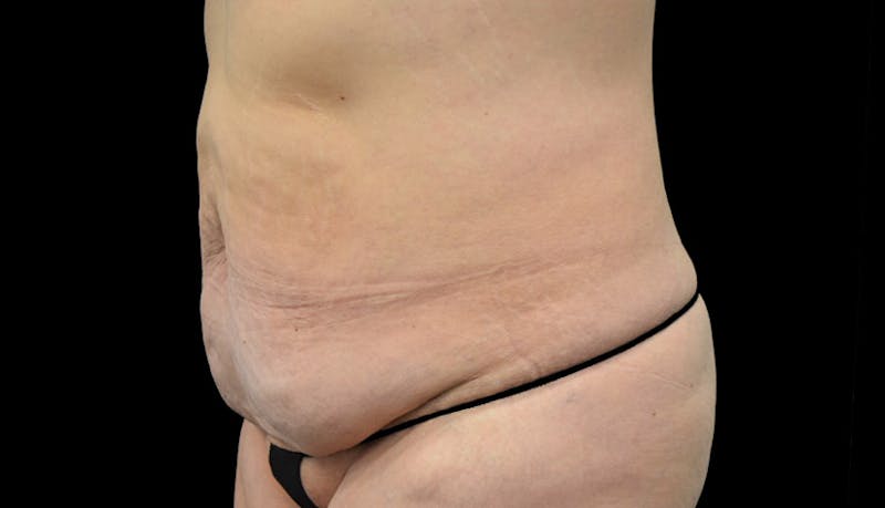 Massive Weight Loss Gallery - Patient 102563717 - Image 3