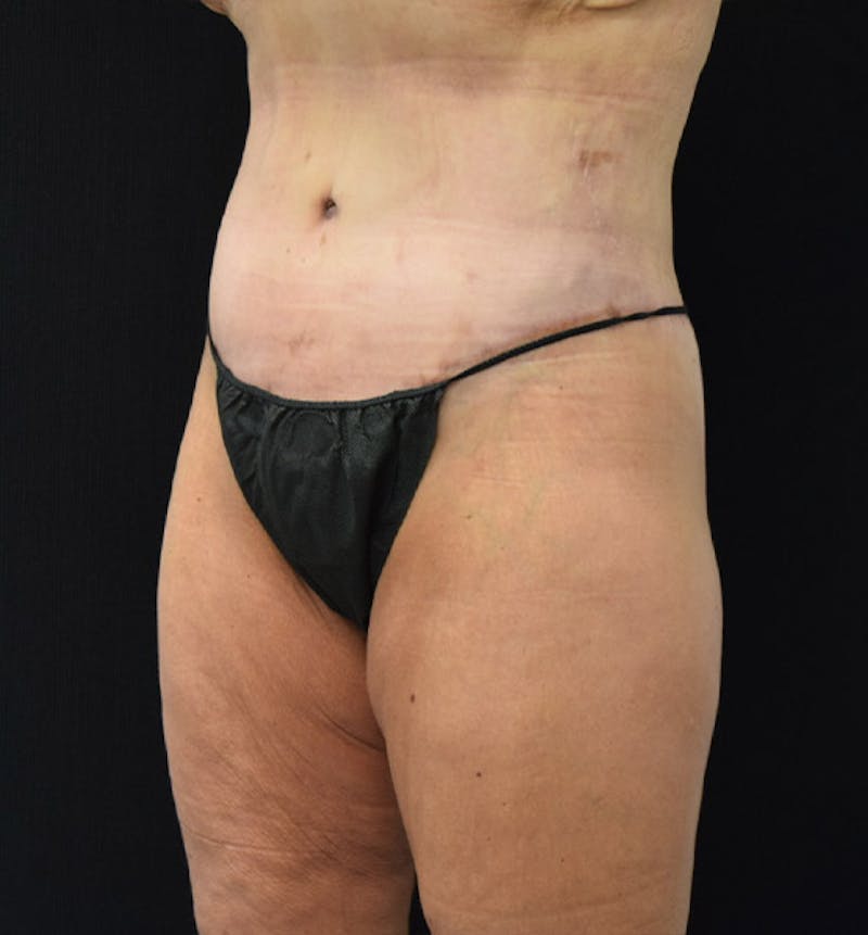 Lower Body Lift Before & After Gallery - Patient 102457163 - Image 8