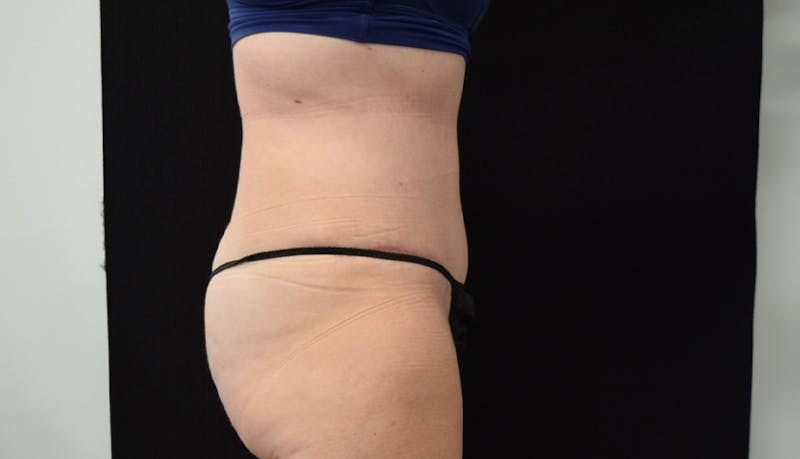 Abdominoplasty Before & After Gallery - Patient 102468564 - Image 6