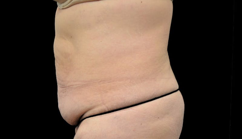 Massive Weight Loss Before & After Gallery - Patient 102563717 - Image 5