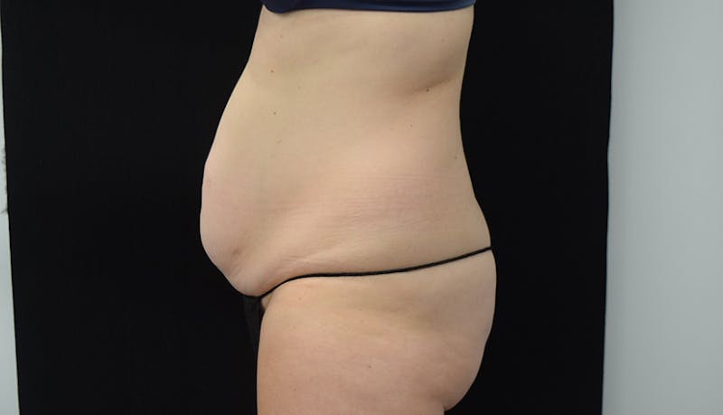 Abdominoplasty Before & After Gallery - Patient 102468564 - Image 7
