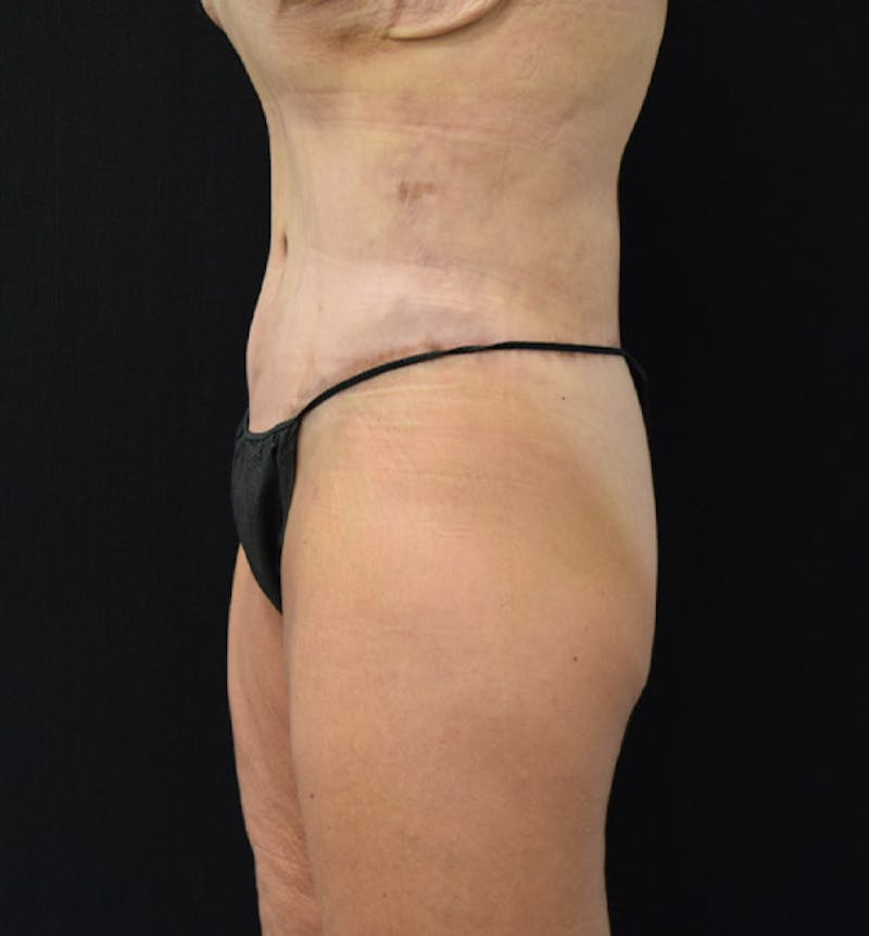 Lower Body Lift Before & After Gallery - Patient 102457163 - Image 10