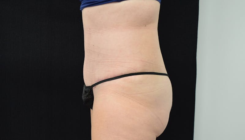 Abdominoplasty Before & After Gallery - Patient 102468564 - Image 8