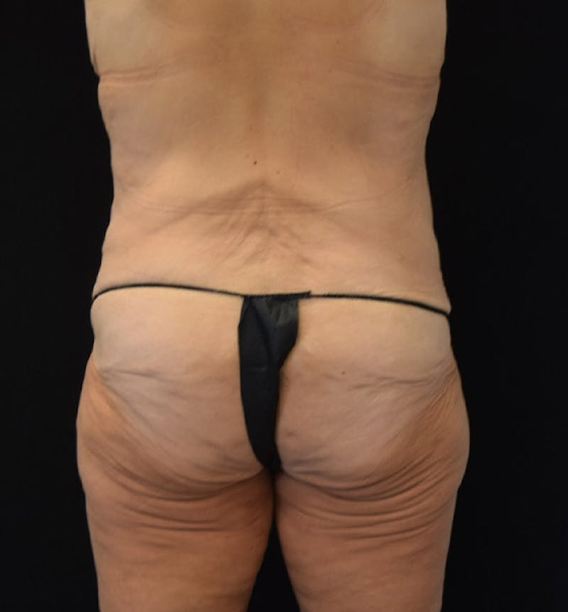 Lower Body Lift Before & After Gallery - Patient 102457163 - Image 11